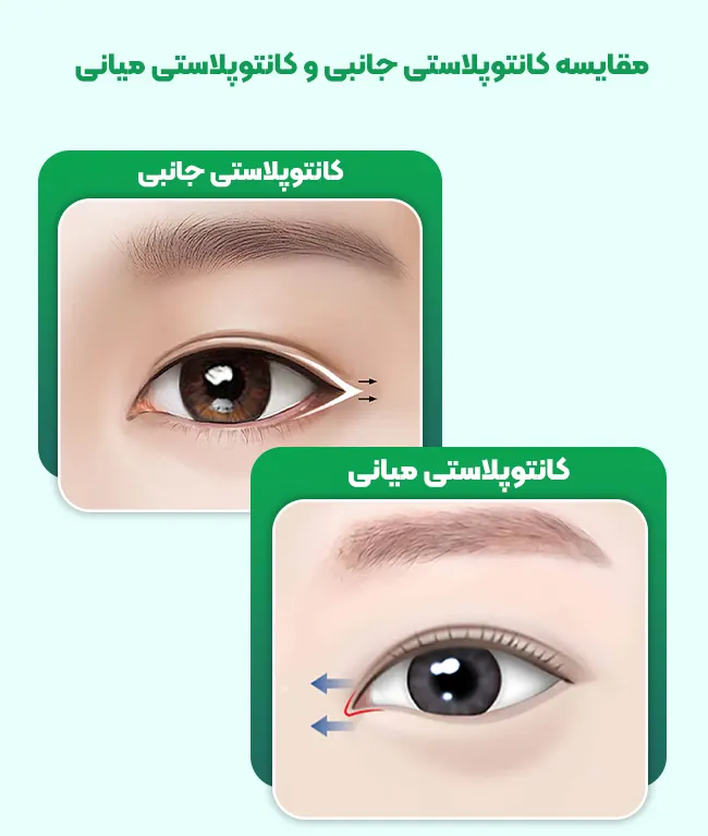 مقایسه کانتوپلاستی جانبی و کانتوپلاستی میانی