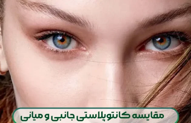 مقایسه کانتوپلاستی جانبی و کانتوپلاستی میانی