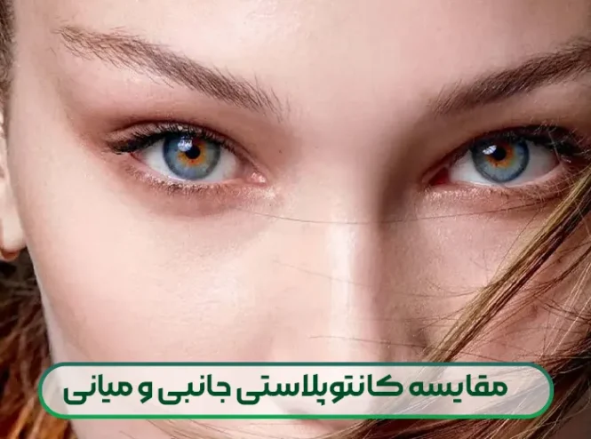 مقایسه کانتوپلاستی جانبی و کانتوپلاستی میانی