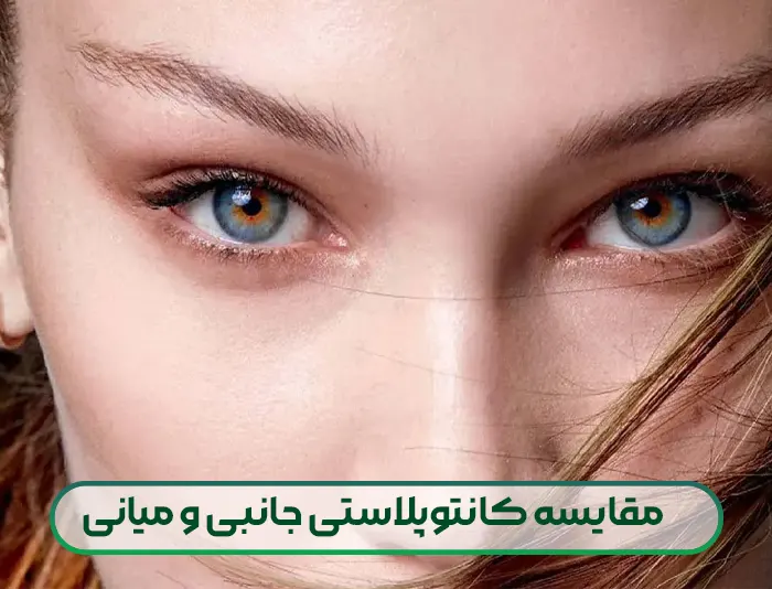 مقایسه کانتوپلاستی جانبی و کانتوپلاستی میانی