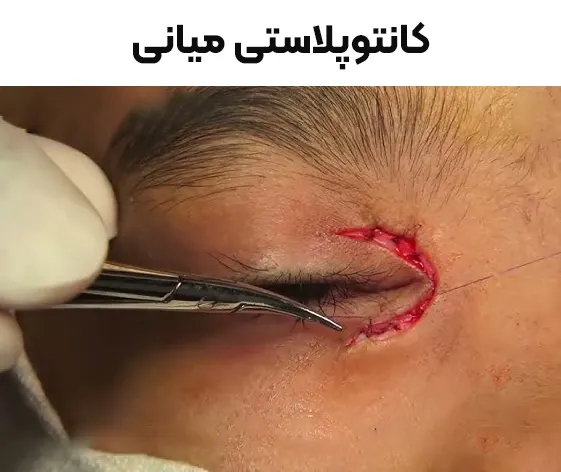 کانتوپلاستی میانی