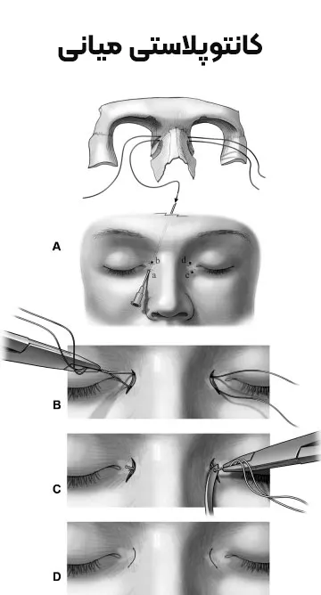 کانتوپلاستی میانی