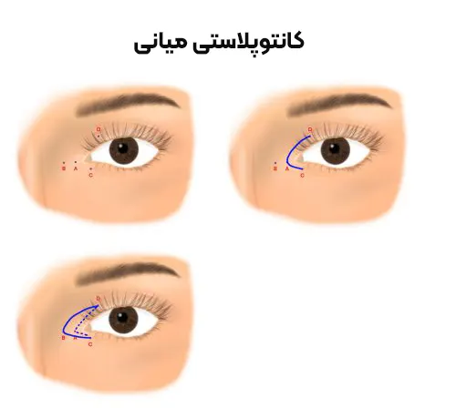 کانتوپلاستی میانی