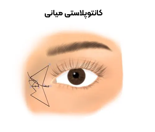 کانتوپلاستی میانی