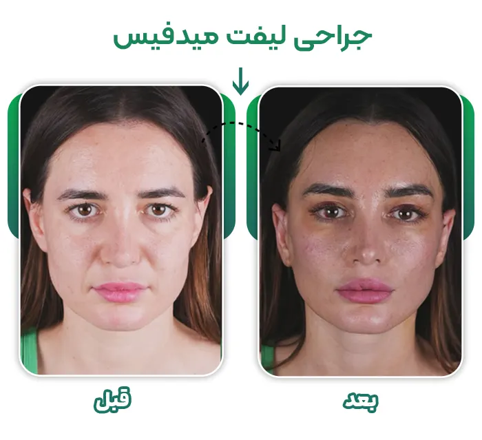 جراحی لیفت میدفیس
