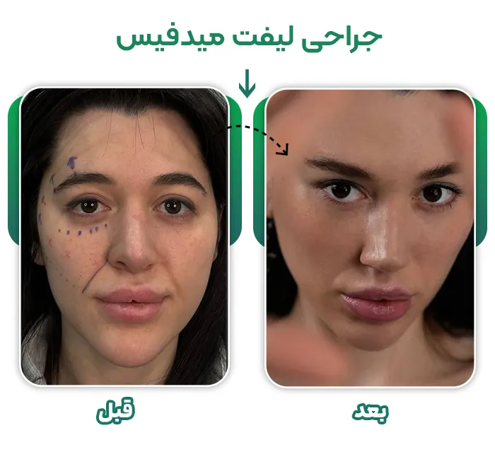 جراحی لیفت میدفیس