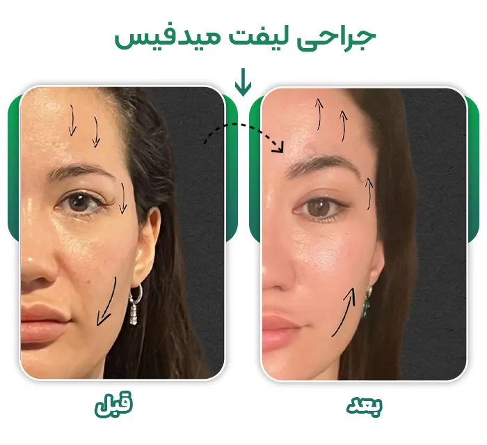 جراحی لیفت میدفیس
