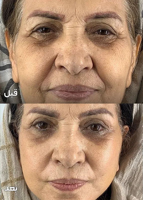 جراحی لیفت میدفیس