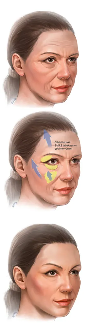 جراحی لیفت میدفیس