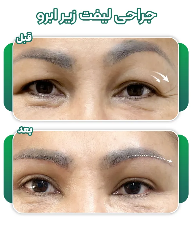 لیفت زیر ابرو