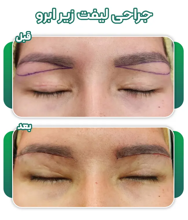 لیفت زیر ابرو