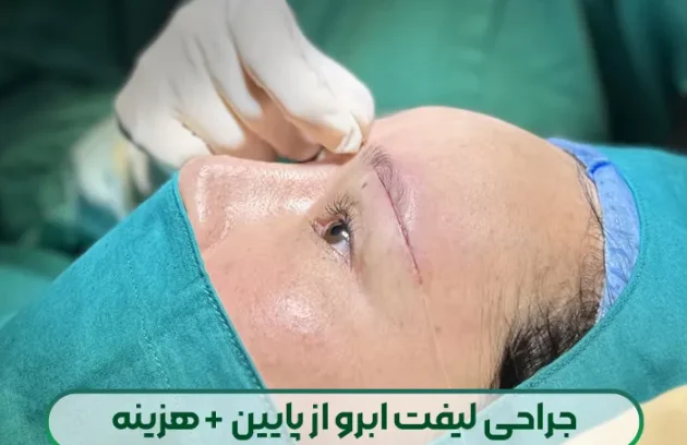 جراحی لیفت زیر ابرو