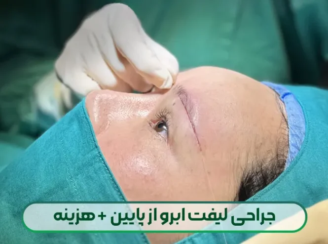 جراحی لیفت زیر ابرو