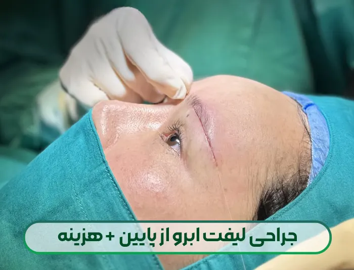 جراحی لیفت زیر ابرو