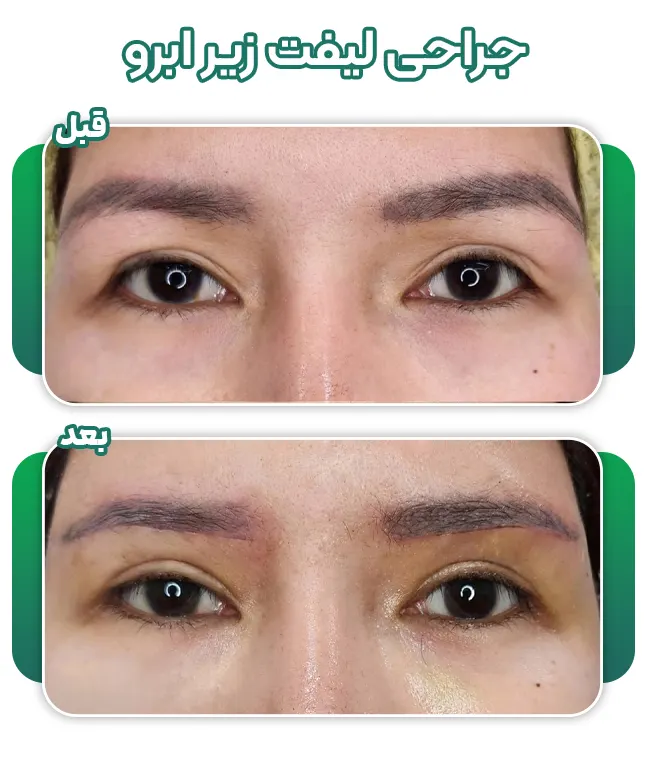 لیفت دایرکت ابرو از پایین