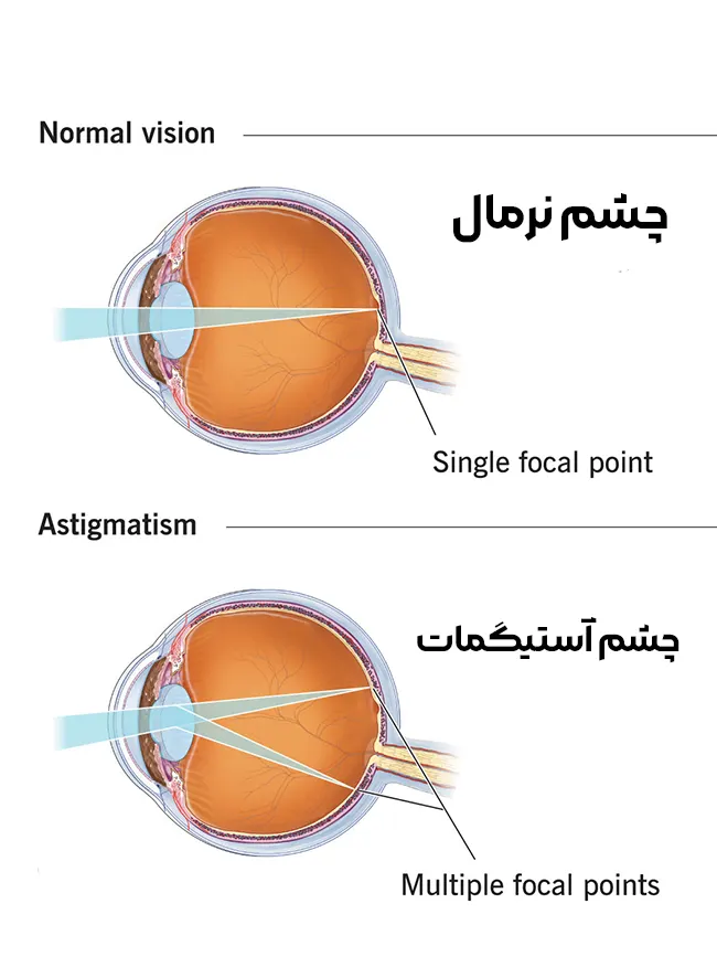 آستیگماتیسم چیست؟