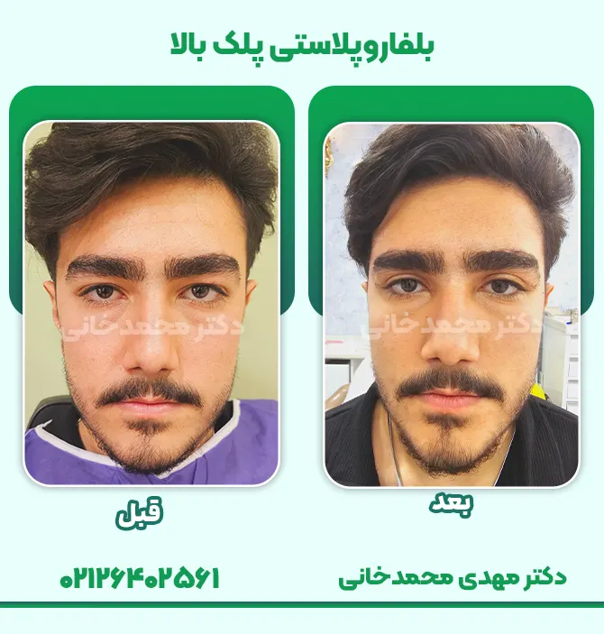 بلفاروپلاستی پلک بالا