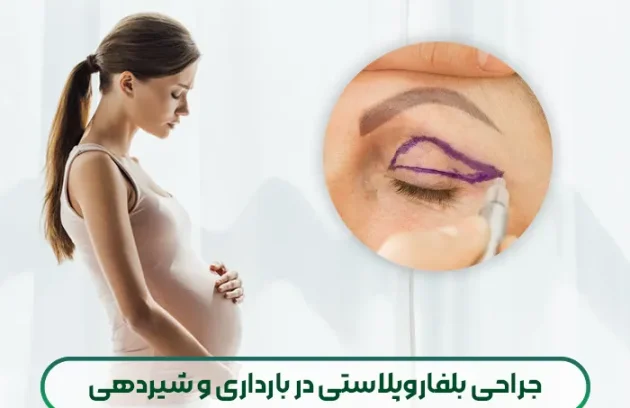 جراحی بلفاروپلاستی در بارداری و شیردهی