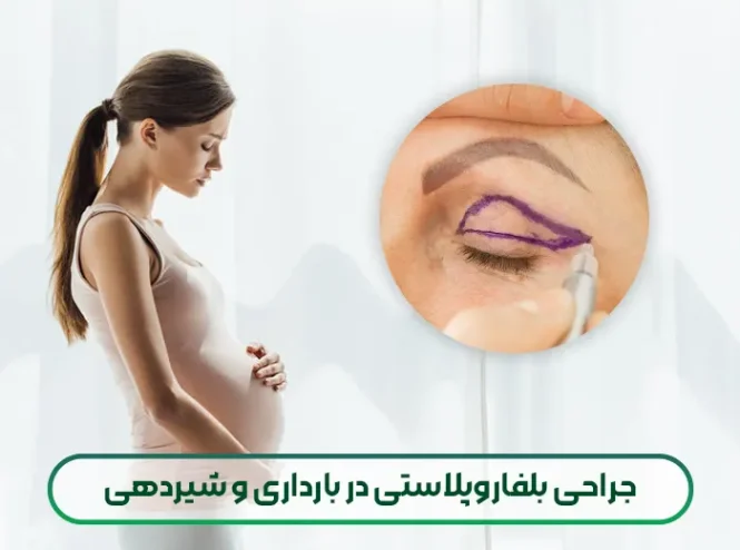 جراحی بلفاروپلاستی در بارداری و شیردهی