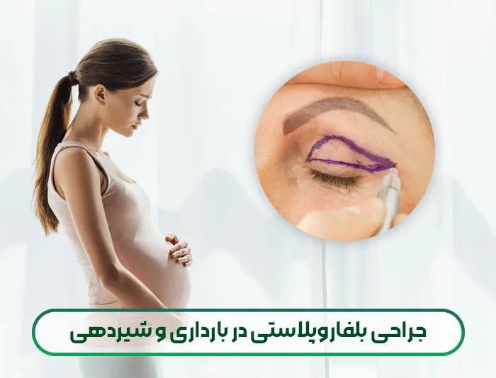 جراحی بلفاروپلاستی در بارداری و شیردهی