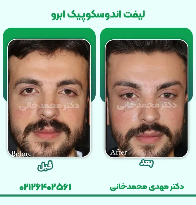 لیفت اندوسکوپیک ابرو