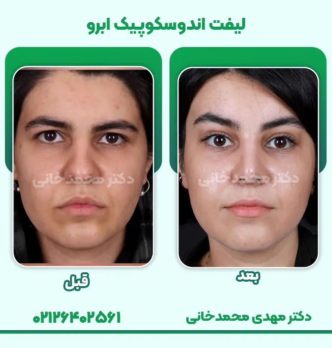 لیفت اندوسکوپیک ابرو