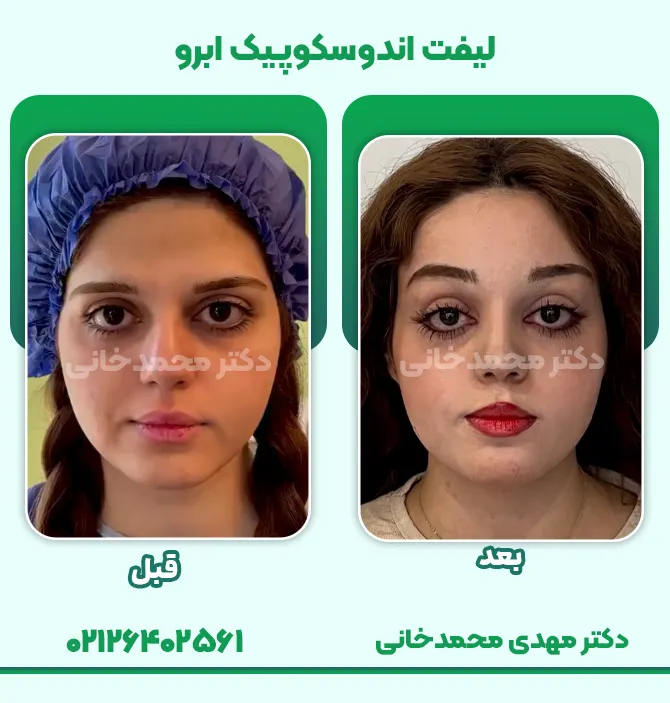 لیفت اندوسکوپیک ابرو