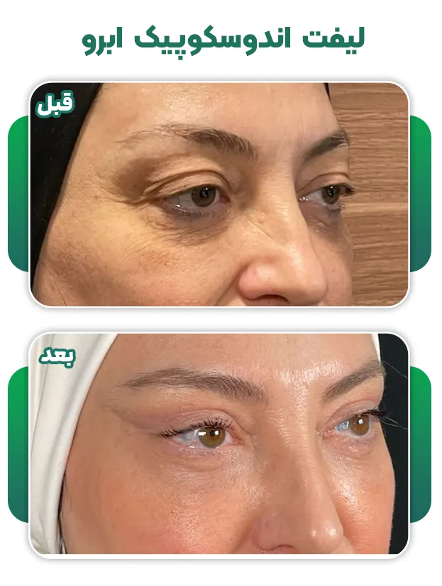 لیفت اندوسکوپیک ابرو