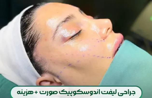 لیفت اندوسکوپیک صورت