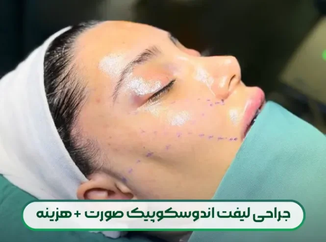 لیفت اندوسکوپیک صورت