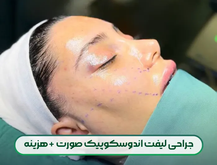 لیفت اندوسکوپیک صورت