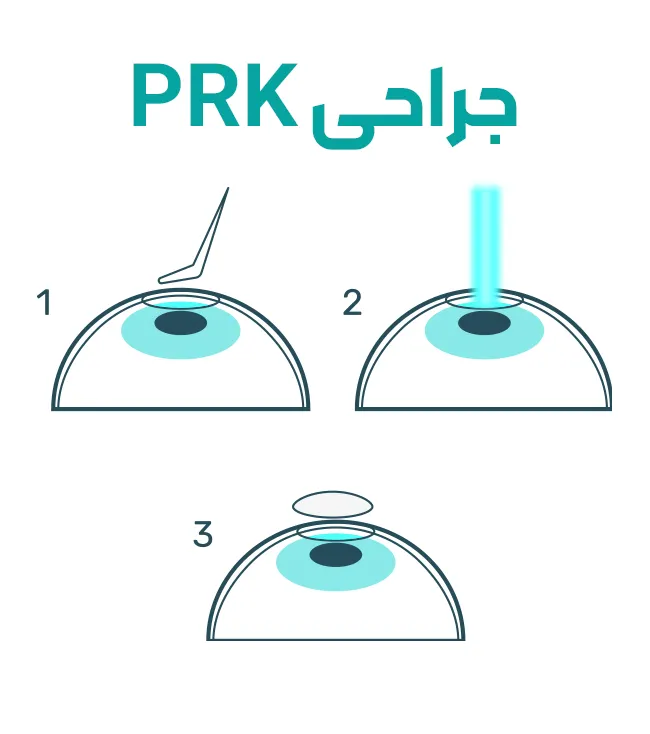 جراحی PRK