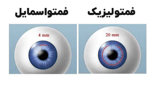 مقایسه فمتولیزیک و فمتو اسمایل