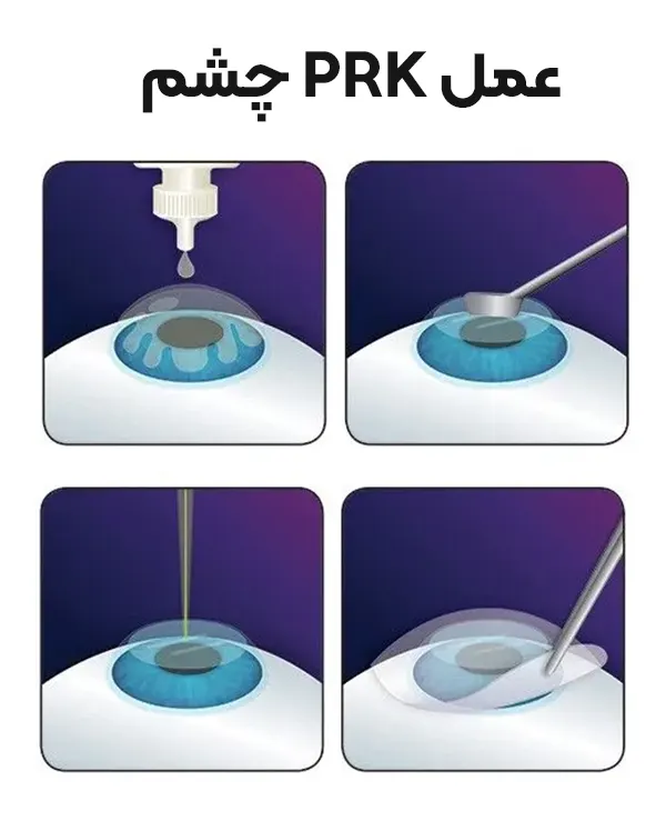 عمل PRK چشم
