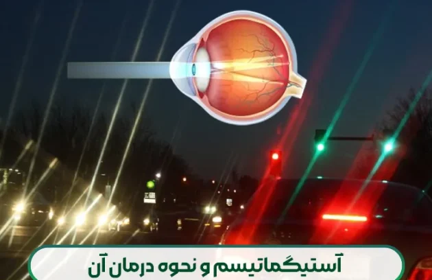 آستیگماتیسم و نحوه درمان آن