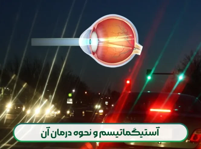 آستیگماتیسم و نحوه درمان آن