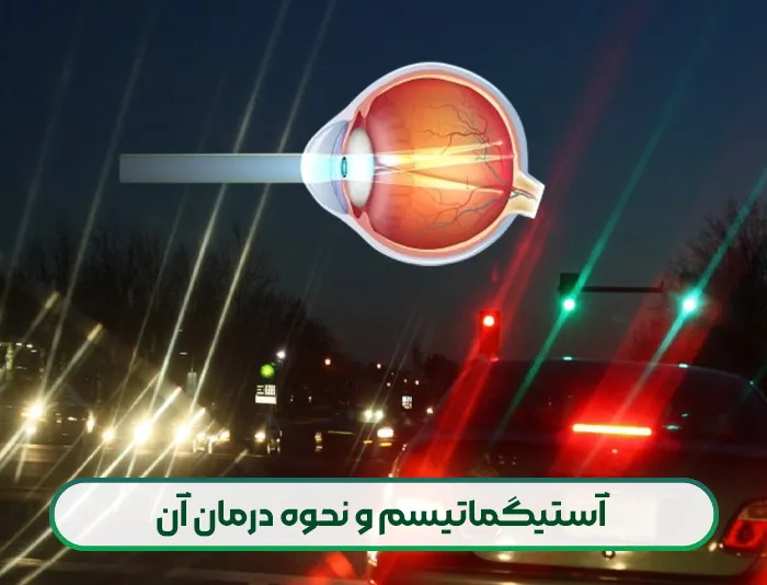 آستیگماتیسم و نحوه درمان آن