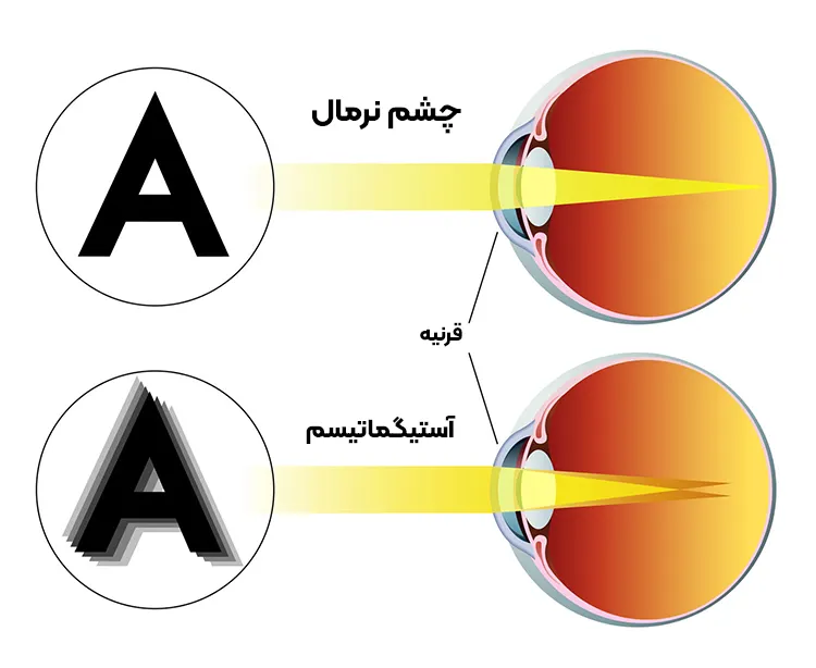 آستیگماتیسم