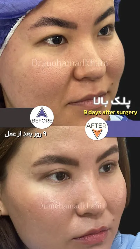 بلفاروپلاستی