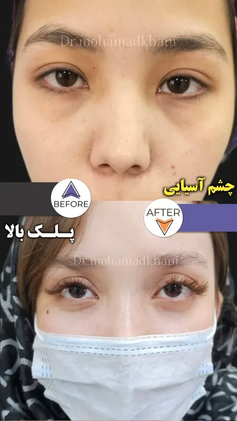 بلفاروپلاستی