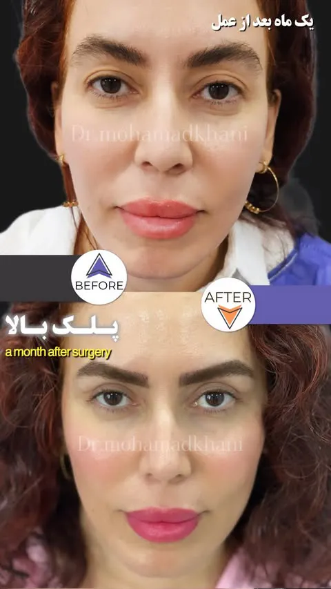 بلفاروپلاستی