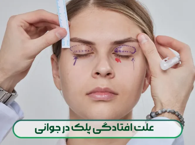 علت افتادگی پلک در جوانی