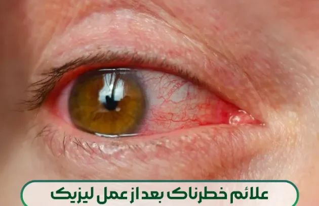 علائم خطرناک بعد از عمل لیزیک