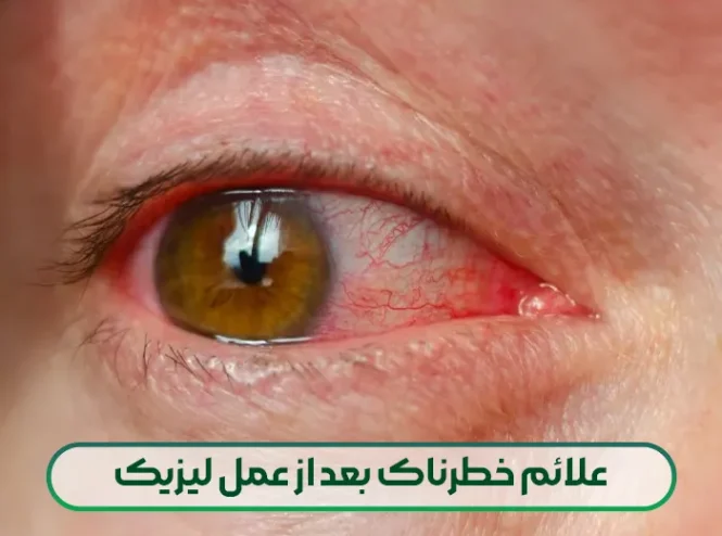 علائم خطرناک بعد از عمل لیزیک