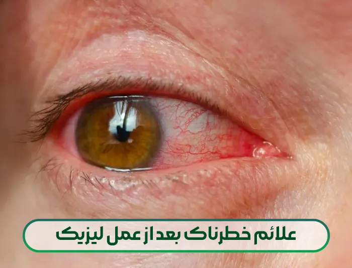 علائم خطرناک بعد از عمل لیزیک