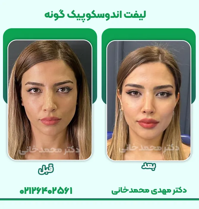 لیفت اندوسکوپیک گونه