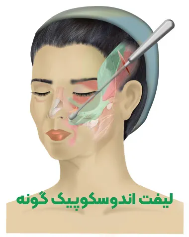 لیفت اندوسکوپیک گونه