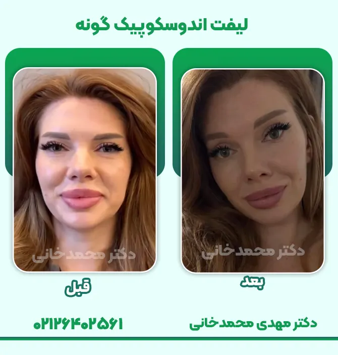 لیفت اندوسکوپیک گونه