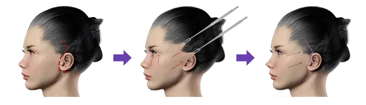 نحوه لیفت اندوسکوپیک گونه