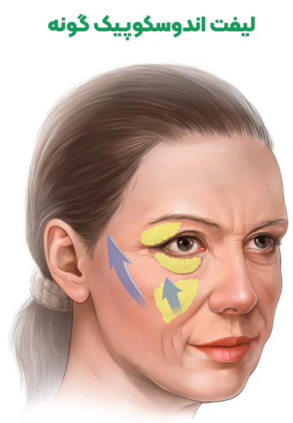 لیفت اندوسکوپیک گونه